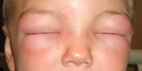 Allergic reactions can vary greatly between each person and the presenting symptoms can rapidly change. In this course, we will discuss multiple factors the nurse should consider when a patient presents with allergy and allergic reaction symptomology. This course sheds light on the many nuances of allergies: an extremely important assessment on any patient presentation.